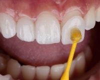 Tips Agar Veneer Gigi Anda Awet dan Tahan Lama