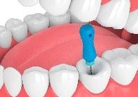 SALAH SATU CARA MEMPERTAHANKAN GIGI ASLI ADALAH DENGAN PERAWATAN SALURAN AKAR